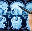 Алгоритм, прогнозирующий припадок эпилепсии за 20 минут, проходит первые испытания