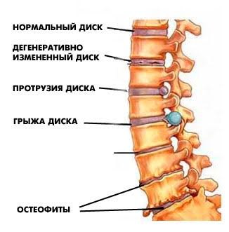 5 советов, чтобы предупредить или избавиться от боли в спине, и 4 популярных заблуждения, которые могут «убить» позвоночник - Медгаджетс