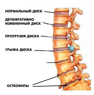 Что делать при острой боли в пояснице, резкая боль в спине: причины и лечение | Клиника Ткачева